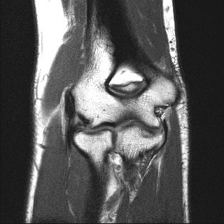 Elbow MRI Anatomy