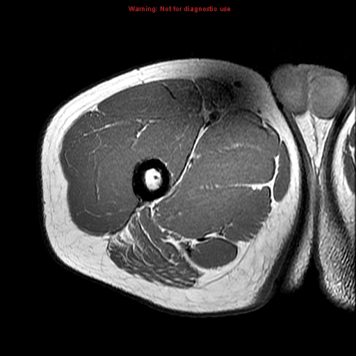 Thigh MRI Anatomy